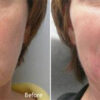 Dermal fillers