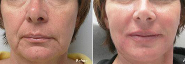 Dermal fillers